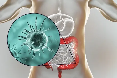 Parasitic Infections